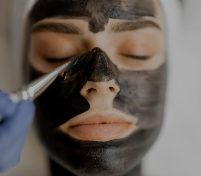 about-carbon-facials