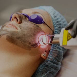 laser-treatment