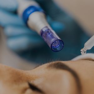 microneedling-treatment
